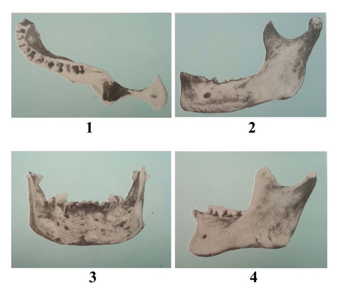사람의 아래턱뼈