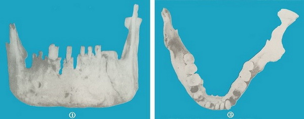 룡곡사람1호아래턱뼈