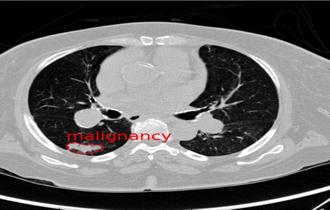 A new method of lung nodule detection in CT scans using 3D U-Net convolutional neural network